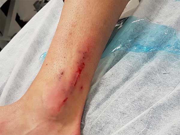 הקרסול הפגוע של פקהארט