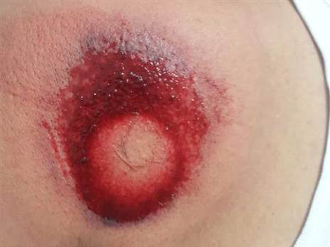 אוהד סכנין שטוען כי נפגע מכדור גומי