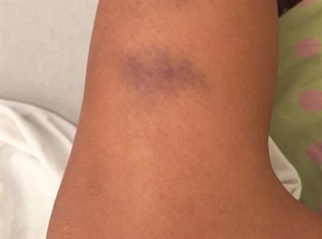 החבלה בגופה של המתלוננת