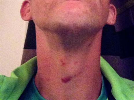 כך נראה הגרון של בוקולי לאחר התיגרה