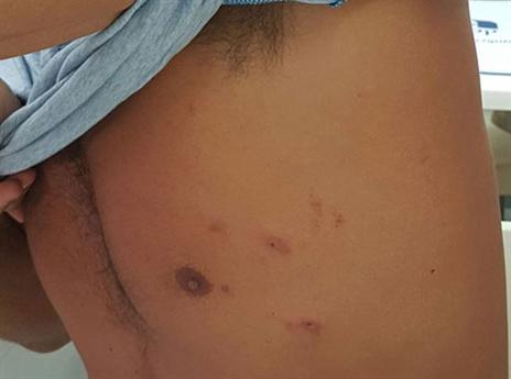 הפצעים בבית החזה של חכמון (מתוך: עמוד הפייסבוק של ליאור חכמון)