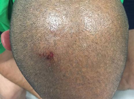 ראשו של בוחבוט לאחר הפציעה