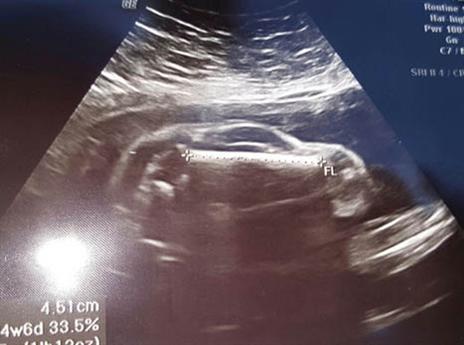 האולטראסאונד המפורסם. תמונה שהפכה ללהיט ברשת