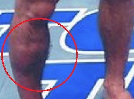 פציעה שתשבית את מקגרגור לחצי שנה?