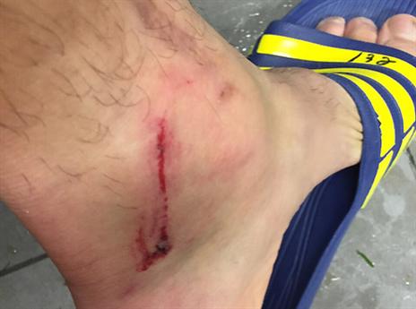 הרגל של בן בסט. קינן עשה את זה?