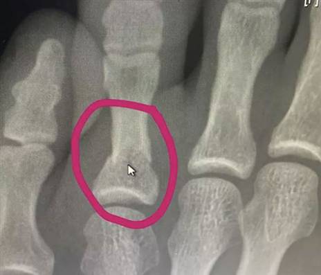 צילום הרנטגן של חאביב