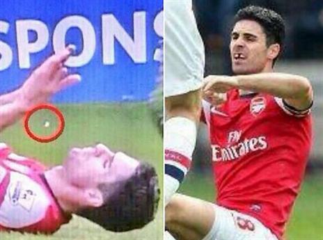 ארטטה איבד שן אי שם על כר הדשא