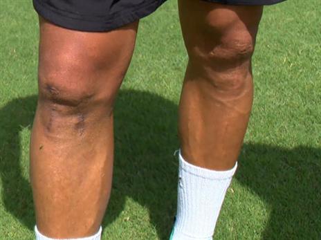 "לכל צלקת יש סיפור"