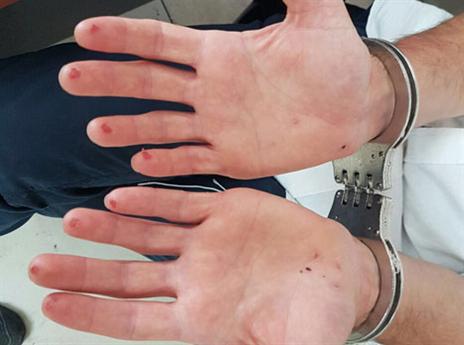 אצבעותיו החתוכות של החשוד (דוברות משטרת ישראל)