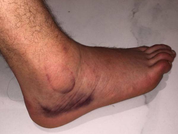 הרגל הפצועה של ניר ביטון